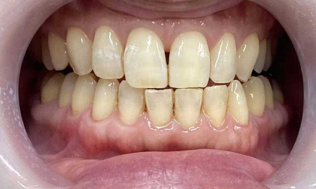 美容ホワイトニング1回after