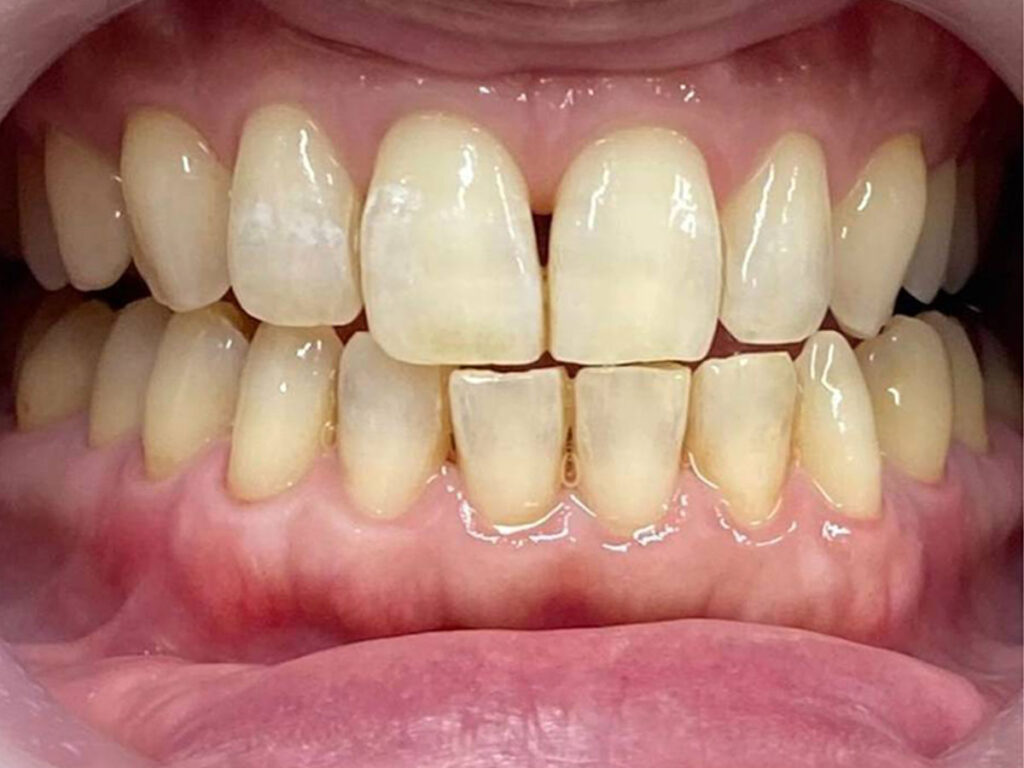 美容ホワイトニング複数回before