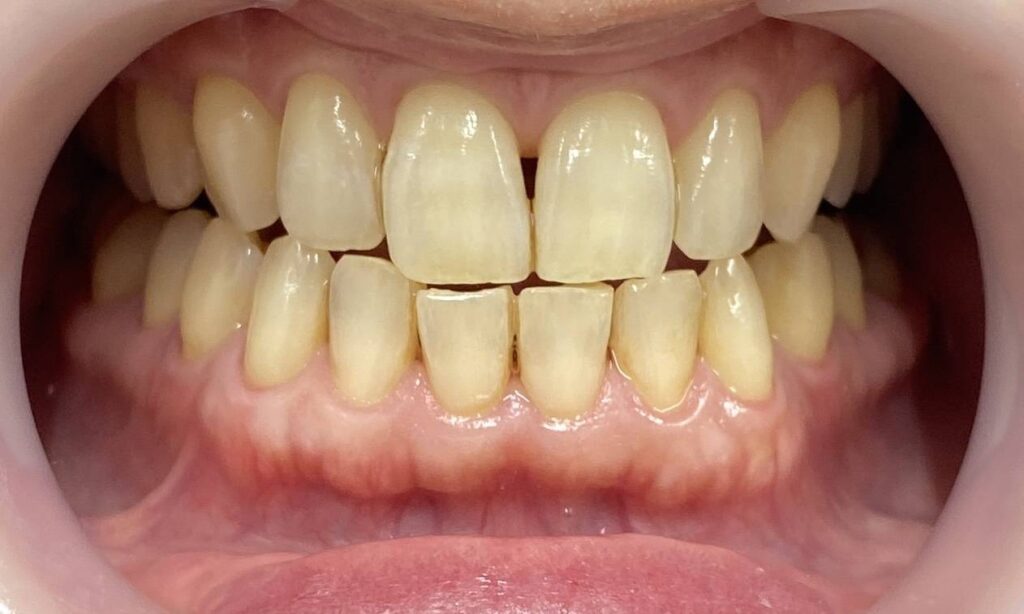 美容ホワイトニング1回before