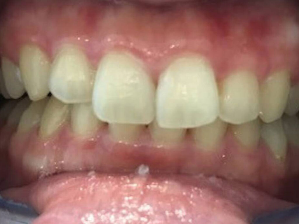 医療ホワイトニング3回before