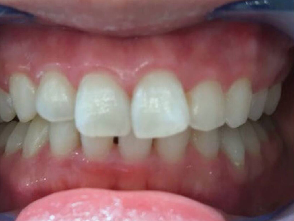 医療ホワイトニング3回after